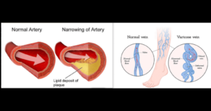Arterial Disease vs Venous Disease aartv
