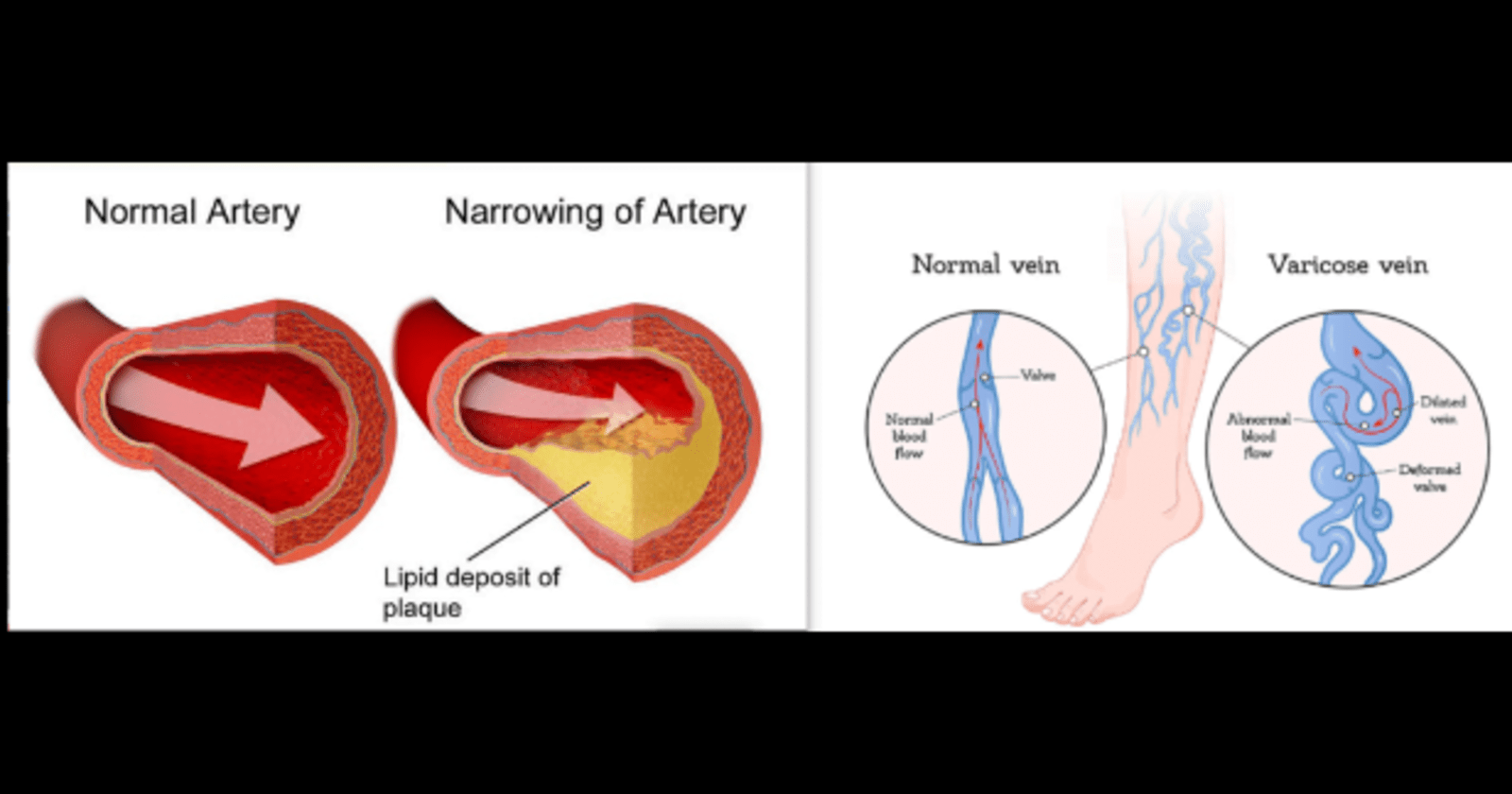 Arterial Disease vs Venous Disease
